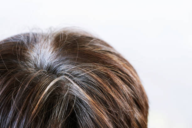 White Hair Before 30? Know the Causes.
